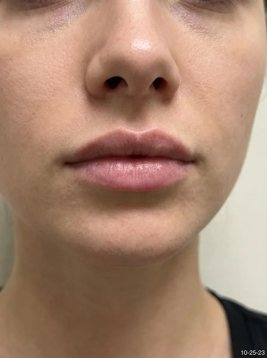 Lip Enhancement — Before
